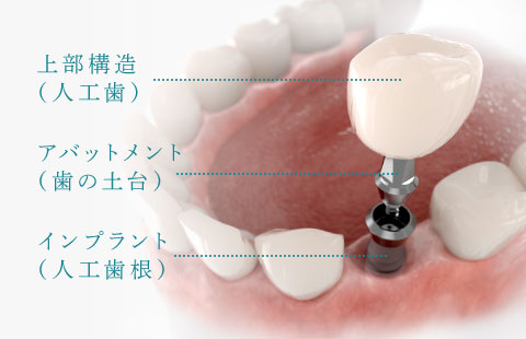 上部構造（人工歯）、アバットメント（歯の土台）、インプラント（人工歯根）