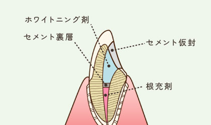 ホワイトニング剤・セメント裏層・セメント仮封・根充剤
